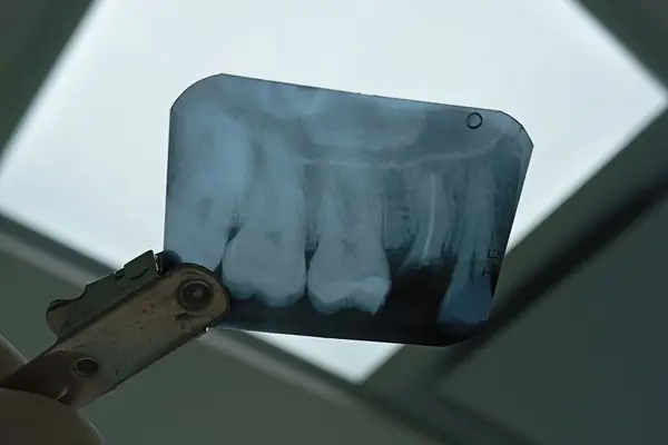 endodoncia130