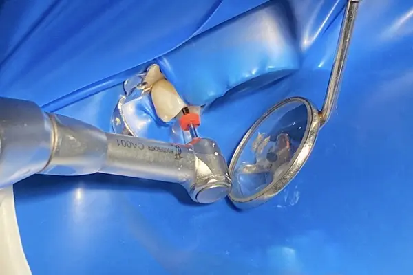 endodoncia140